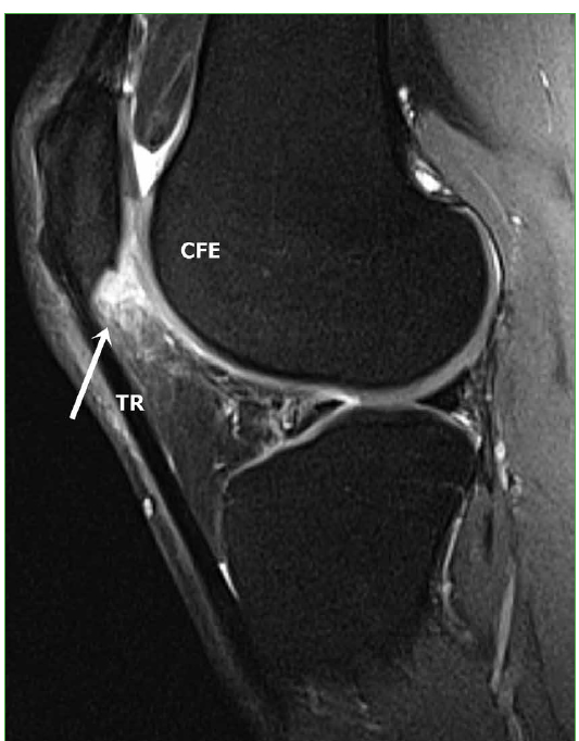 Resonancia magnética de la rodilla derecha. A y B) Secuencias sagital y