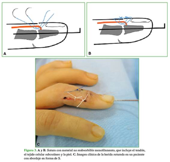 Férula Pulgar de Dedo – Mobility Go