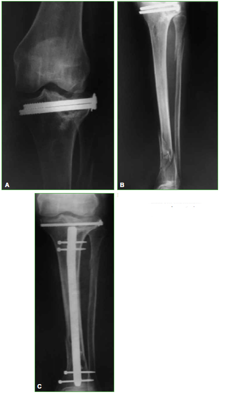 Artrosis de Rodilla – Trauma Advance