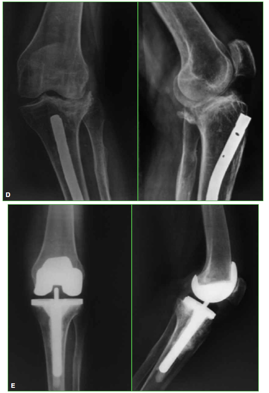 Artrosis de Rodilla – Trauma Advance