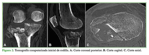 anatomía de la meseta tibial