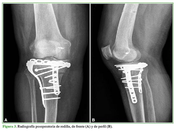 anatomía de la meseta tibial