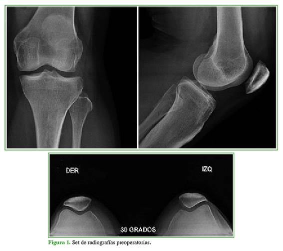 Anatomía de una rodilla normal [4].