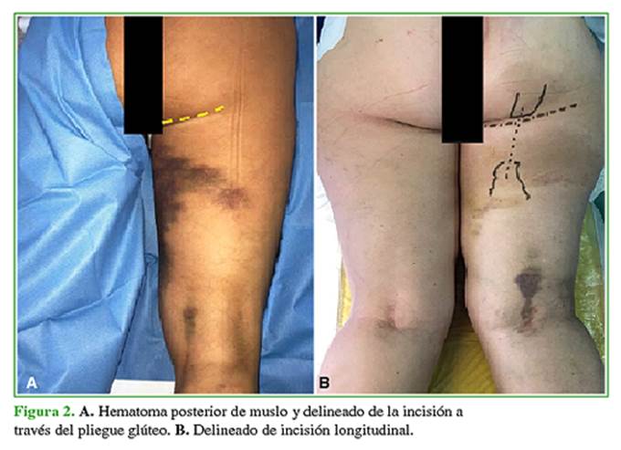 Las 6 lesiones más frecuentes en los glúteos - Clínica Rozalén