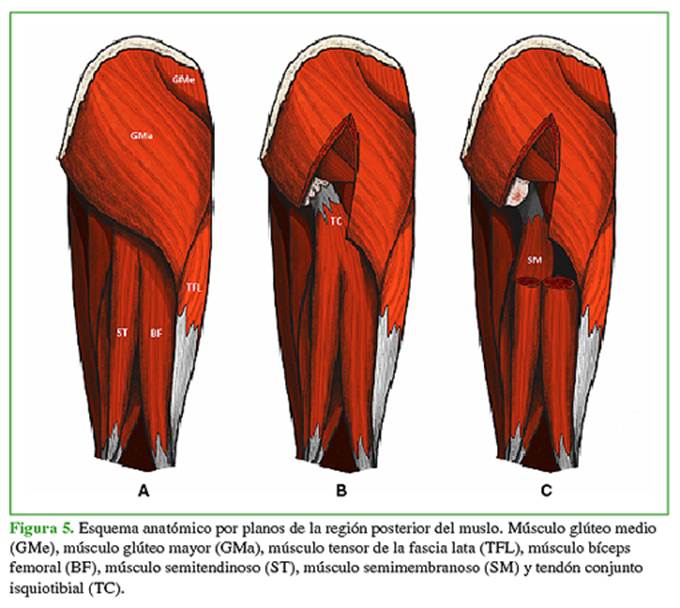 Vista de Variantes quirúrgicas en el tratamiento de la desinserción  proximal de isquiotibiales. Reporte de cuatro casos tratados con cirugía