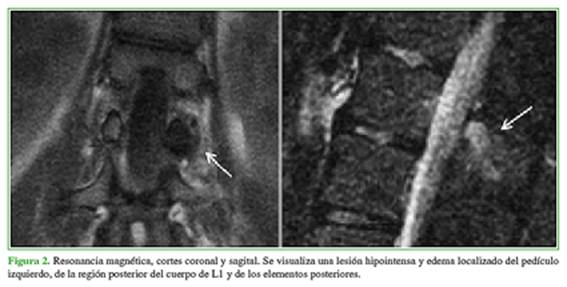 osteoma osteoide columna vertebral