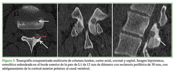 osteoma osteoide columna vertebral