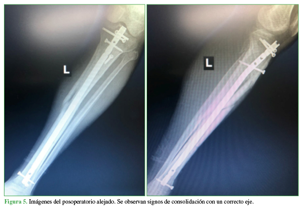 Imágenes del posoperatorio alejado. Se observan signos de consolidación con un correcto eje