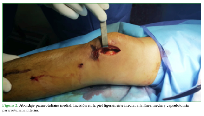 Abordaje pararrotuliano medial. Incisión en la  piel ligeramente medial a la línea media y capsulotomía pararrotuliana interna.