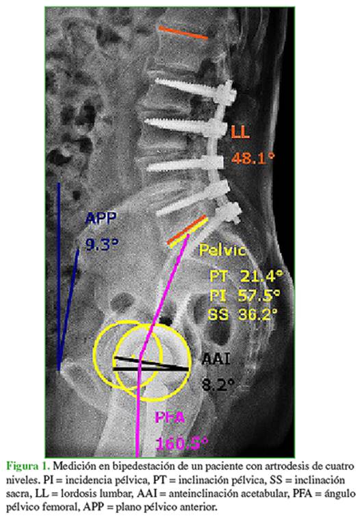 Todo sobre el segmento vertebral L5-S1 (articulación lumbosacra)