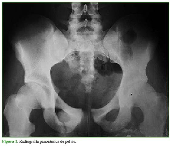 tipos de pelvis