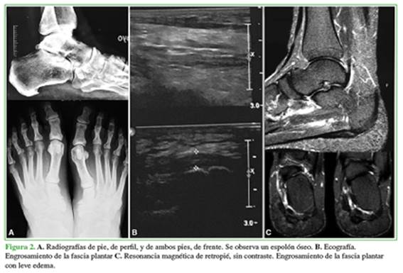 REVISIÓN BIBLIOGRAFICA DE LA FASCITIS PLANTAR