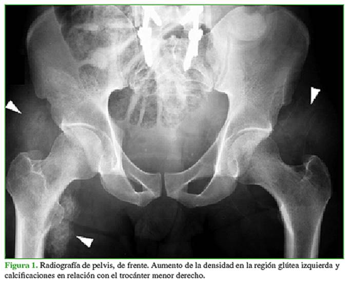 Músculo de los gluteos fotografías e imágenes de alta resolución