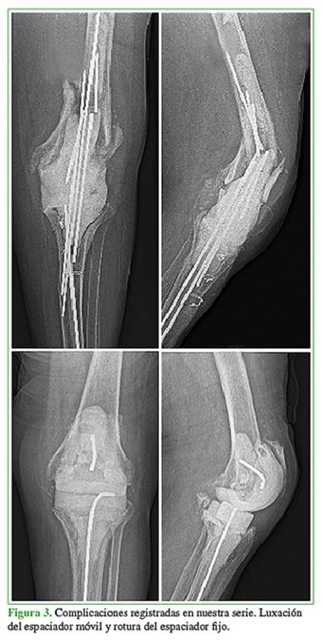 Comportamiento de la infección periprotésica de rodilla