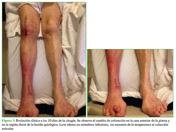 Vista de Trombosis arterial de diagnóstico tardío que simula un síndrome de  Südeck luego de un reemplazo total de rodilla