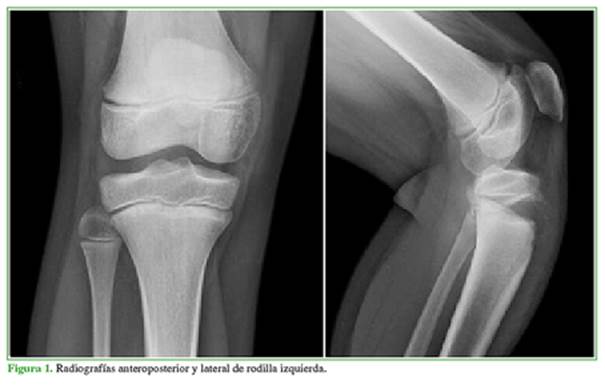 anatomía de la tibia proximal