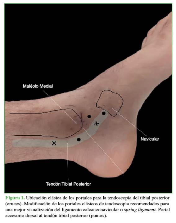 Endoscopic Repair of the Superficial Deltoid Ligament and Spring