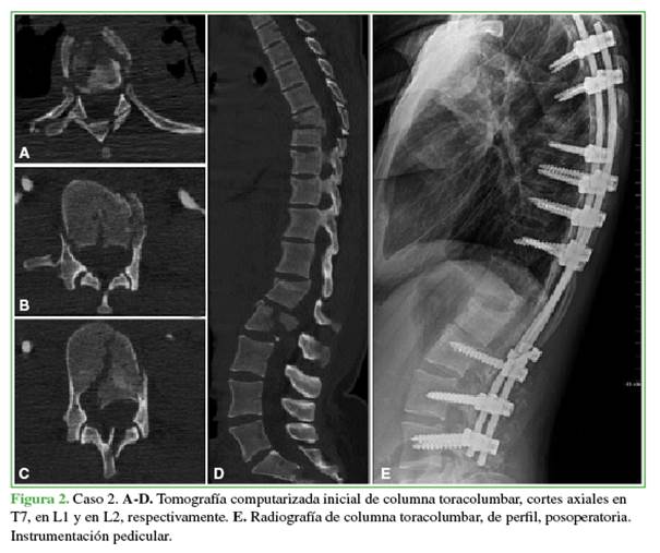 Radiografía de la columna lumbar, perfil