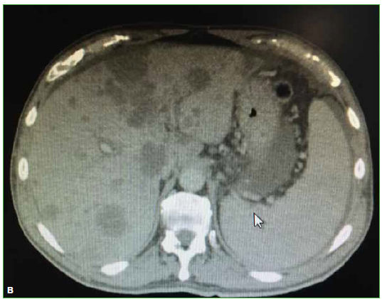 Faja Lumbar L2L3