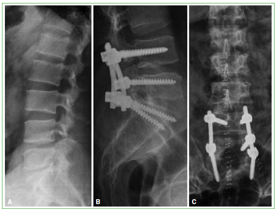 Resonancia magnética de columna lumbar simple en Hospital San José