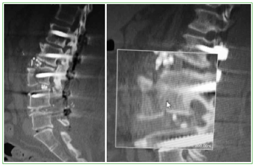 Complicaciones tempranas en los primeros 50 casos de cirugía mínimamente  invasiva lateral a la columna lumbar