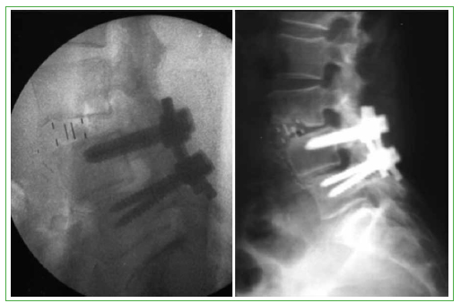 Cirugía de columna lumbar - Serie—Procedimiento: MedlinePlus