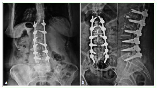 Cirugía de columna lumbar - Serie—Procedimiento: MedlinePlus