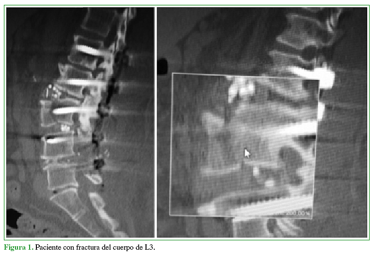 Complicaciones tempranas en los primeros 50 casos de cirugía mínimamente  invasiva lateral a la columna lumbar