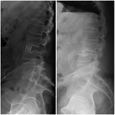 Complicaciones tempranas en los primeros 50 casos de cirugía mínimamente  invasiva lateral a la columna lumbar